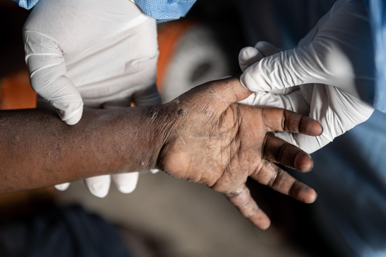 WHO Reports Over 1,500 New Mpox Cases in Africa Amid Ongoing Outbreaks